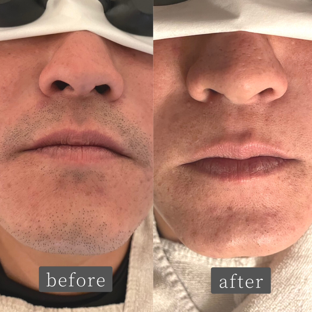 ひげ脱毛Before▶︎▶︎After