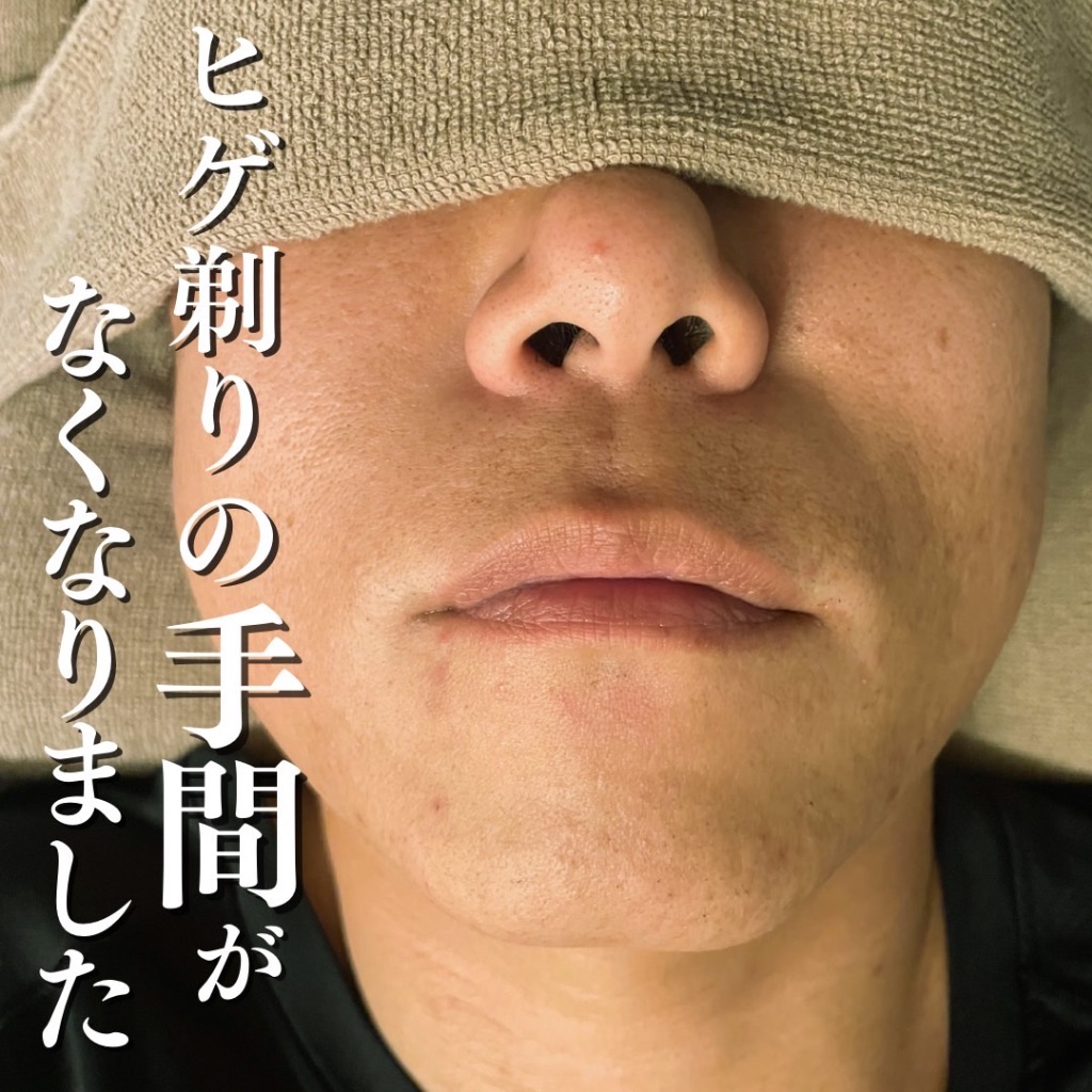 ひげ剃りの手間がなくなりました！