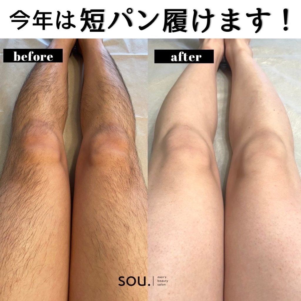 ヒゲ脱毛に次ぐ人気の足脱毛🦵