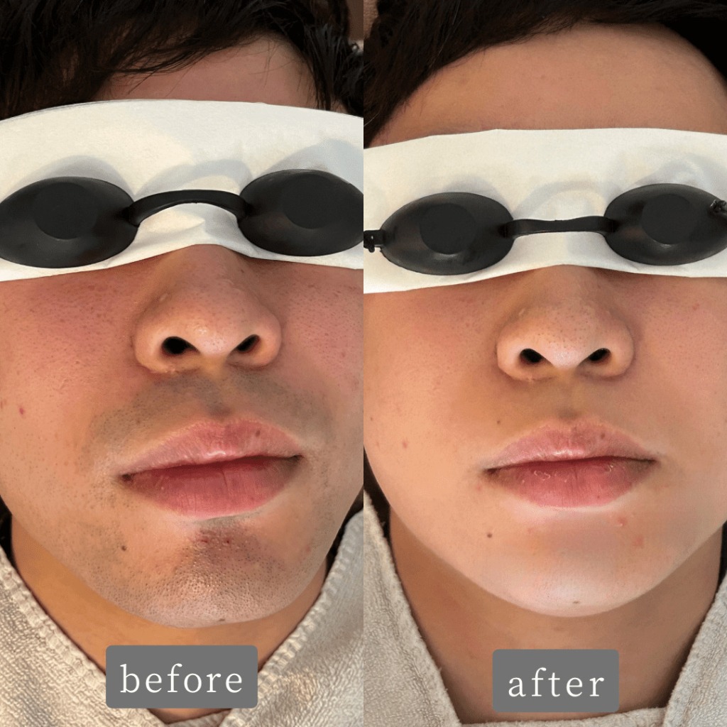 ヒゲ脱毛Before→After✨