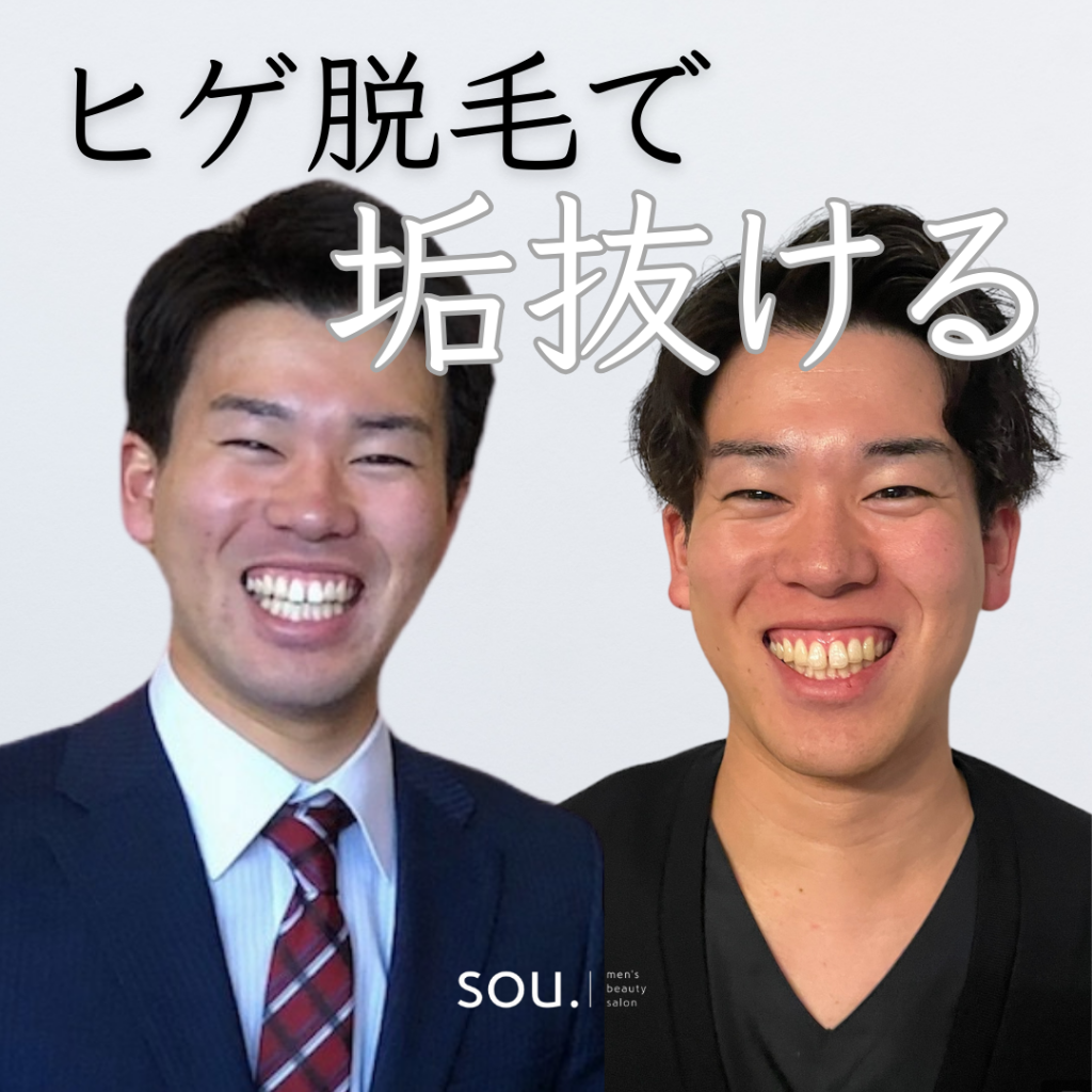 sou.津幡店の北角店長のひげ脱毛ビフォーアフターです💡