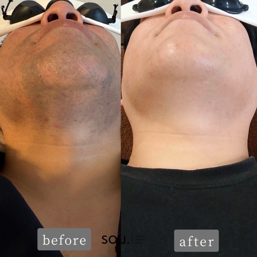 ＼30代からのお肌にも「ヒゲ脱毛」がおすすめ！／