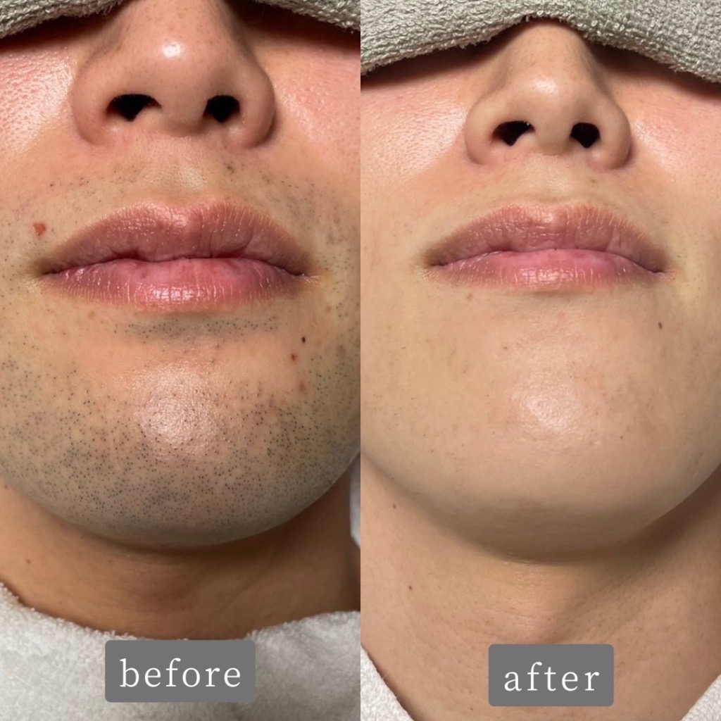 青ヒゲのお悩みお任せください！