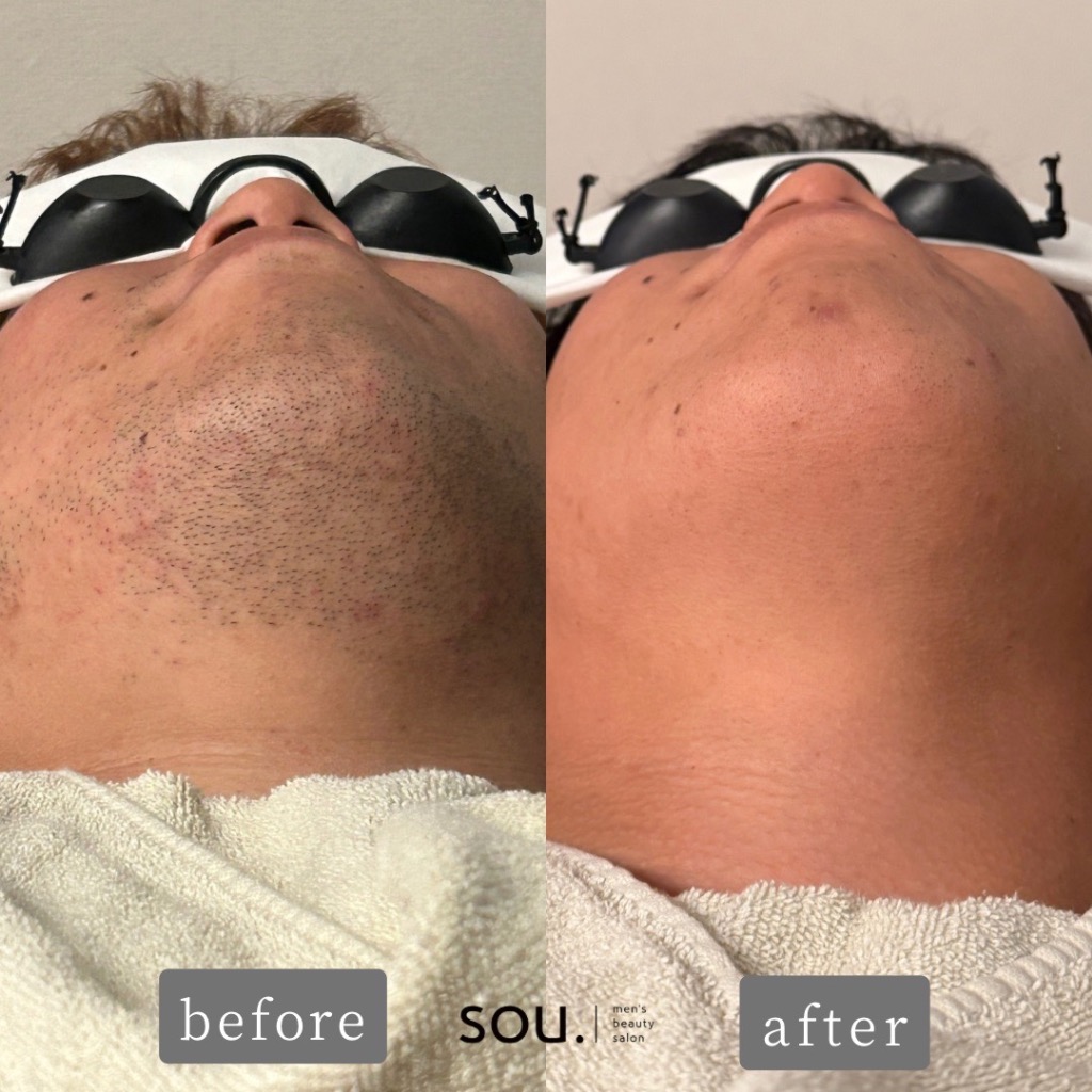 ヒゲ脱毛したいけど「どこに行けばいいか分からない」