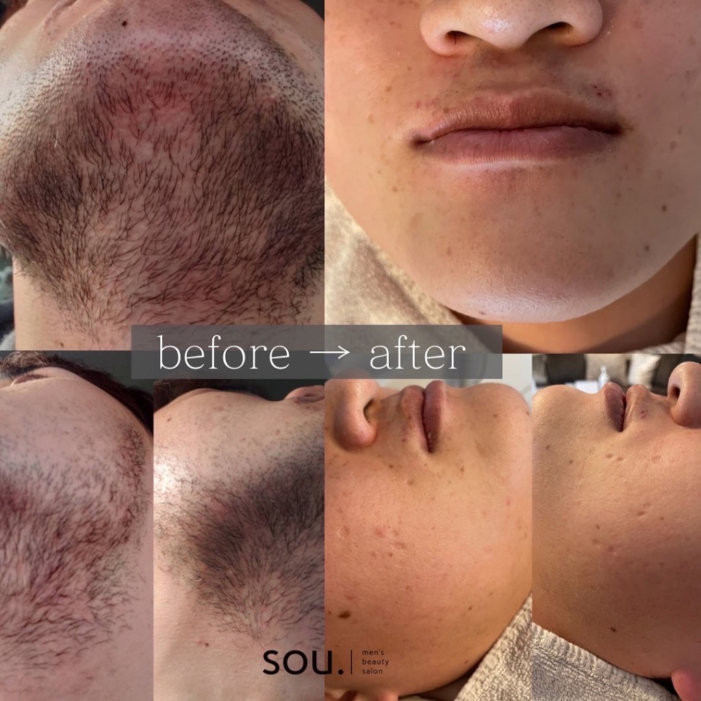長年のお悩み解決！もうヒゲで悩ませない！