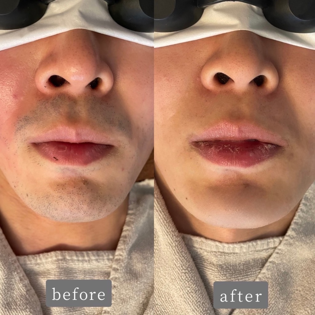 「ヒゲ剃りが無くなったら肌も綺麗になるんですね！」